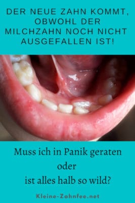 Neuer Zahn, aber Milchzahn ist noch nicht ausgefallen [Ratgeber]